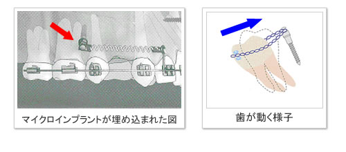 �C���v�����g�����@�C���[�W