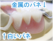 白いバネの部分入れ歯