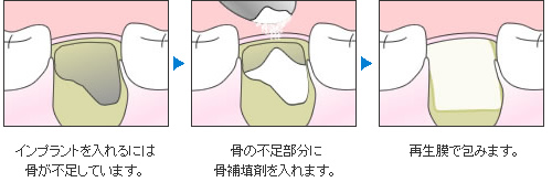 GBR手順